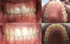 caso real de ortodoncia invisible niños - The dental clinic
