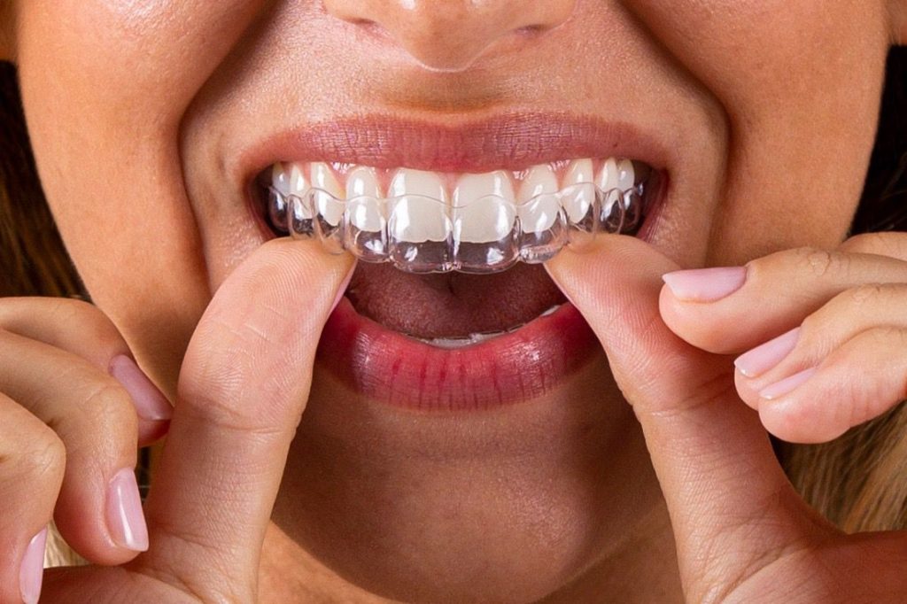 alineadores invisibles Lima - The dental clinic