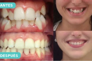 ortodoncia invisible Lima antes y después - The Dental Clinic