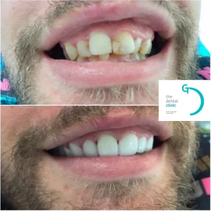 curaciones dentales estéticas en Lima - composite resin fillings in Lima