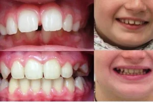 caso real de odontopediatría en Lima - The Dental Clinic