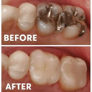 curaciones de dientes en Lima - aesthetic fillings in Lima