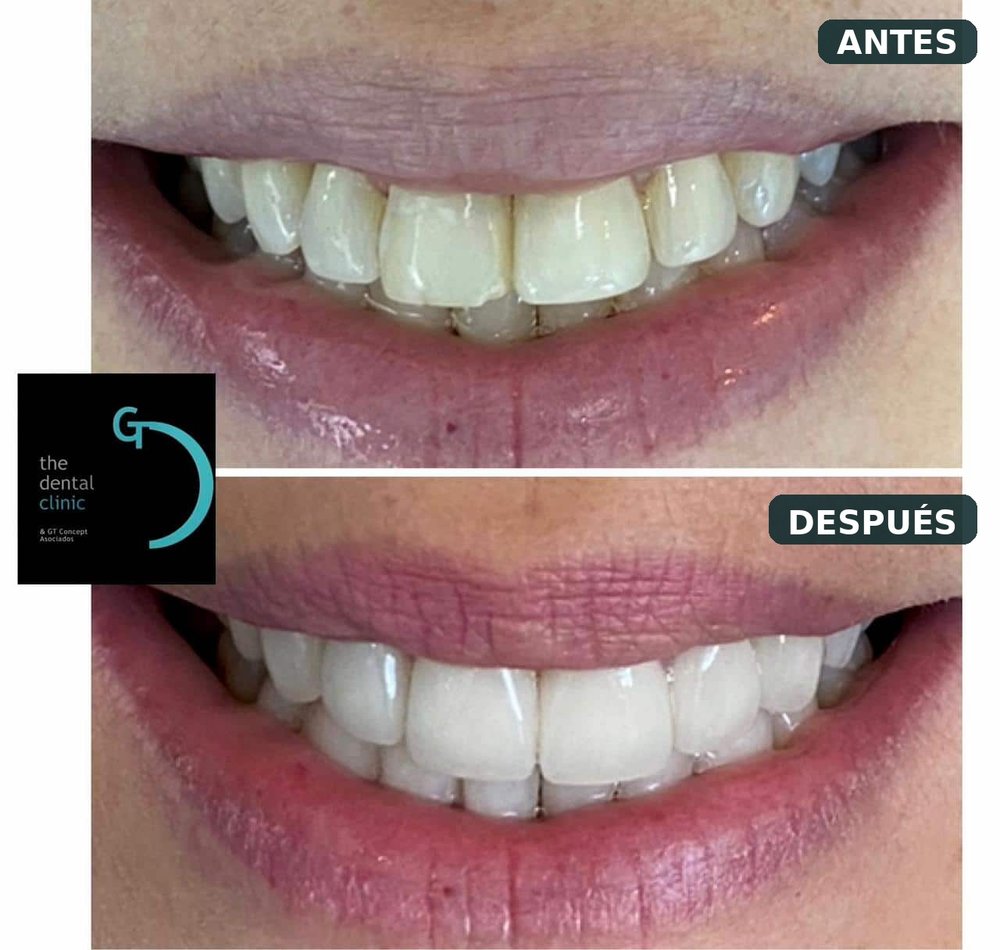 Cosmetica adesiva con porcelana - The dental clinic