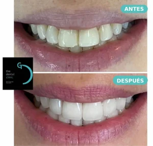 Bonding dental con cosmética adhesiva — caso real antes y después, The Dental Clinic Lima