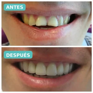 Caso de desgaste dental por bruxismo tratado en Lima - antes y después, The Dental Clinic