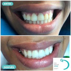 Resultado de carillas dentales: sonrisa antes y después — The Dental Clinic