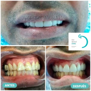Rehabilitación estética con carillas: antes y después — The Dental Clinic
