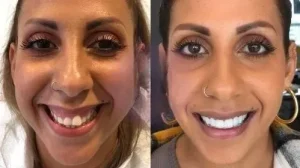 Antes y después de un tratamiento con carillas dentales — The Dental Clinic Lima