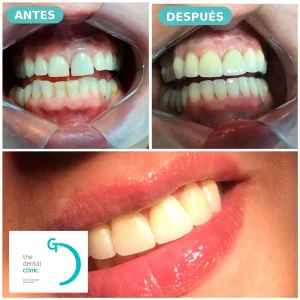 Bonding dental con cosmética adhesiva — caso real antes y después, The Dental Clinic Lima