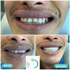 Rehabilitación con coronas tras desgaste dental por bruxismo — The Dental Clinic