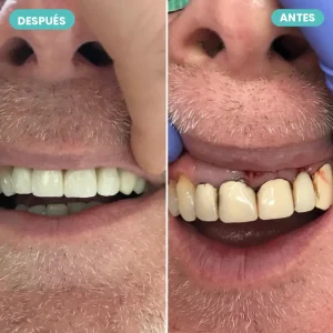 Caso real de coronas de porcelana: antes y después — The Dental Clinic