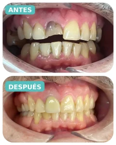 Caso real de diseño de sonrisa antes y después en Lima - The Dental Clinic