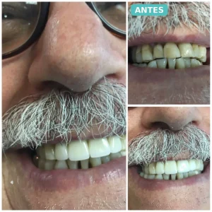Caso real de rehabilitación y diseño de sonrisa, antes y después en Lima - The Dental Clinic
