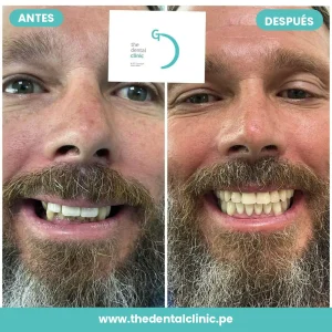 Caso real de rehabilitación con implantes dentales: antes y después — The Dental Clinic