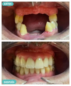 Caso real de prótesis dental removible: antes y después — The Dental Clinic