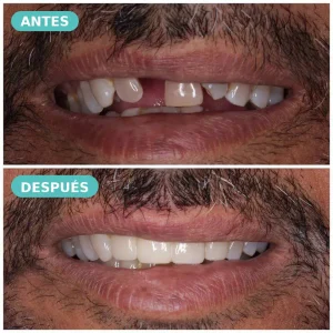 Caso real de prótesis dental fija superior — antes y después, The Dental Clinic