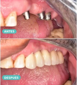 Caso real de rehabilitación con coronas sobre implantes y dientes naturales — antes y después, The Dental Clinic Lima