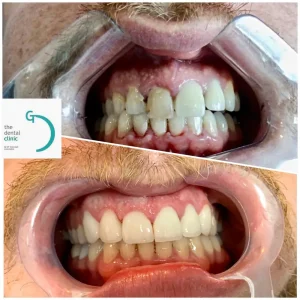 Caso de raspado y alisado radicular en Lima - salud de las encías antes y después, The Dental Clinic