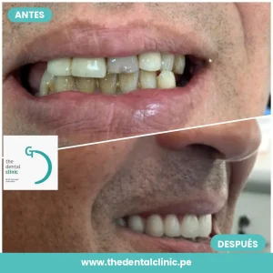 Caso real de rehabilitación dental: antes y después — The Dental Clinic