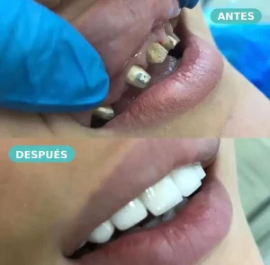Caso real de rehabilitación con coronas sobre implantes y dientes naturales — antes y después, The Dental Clinic Lima