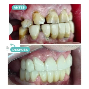 Caso real de rehabilitación oral con implantes dentales — antes y después, The Dental Clinic Lima