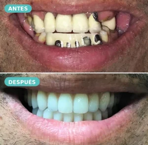 Caso real de rehabilitación oral con prótesis — antes y después, The Dental Clinic