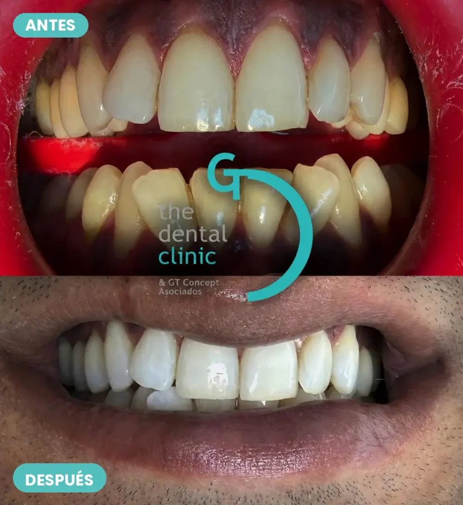 Caso real de blanqueamiento dental: antes y después — The Dental Clinic