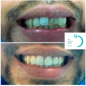 Caso real de endodoncia en Lima - diente antes y después del tratamiento de conductos