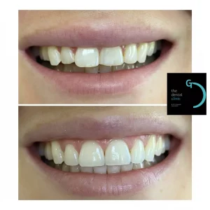 Cosmética adhesiva - The dental clinic