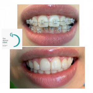 brackets esteticos en Lima