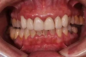 Encías con gingivitis antes del raspado y alisado radicular - The Dental Clinic Lima