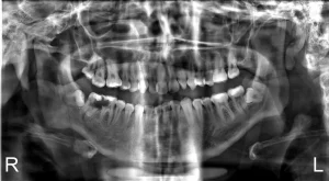 Radiografía panorámica que muestra una muela del juicio impactada