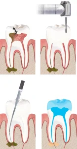 Tratamiento de endodoncia en Lima - The Dental Clinic