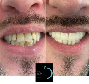 Corona de zirconio realizada en The Dental Clinic