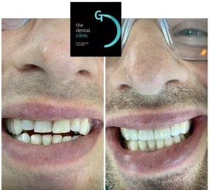 Resultado de un tratamiento con carillas de porcelana, The dental clinic