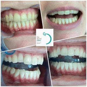 blanqueamiento dental pacientes internacionales