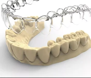 Férula de descarga para bruxismo hecha a medida - The Dental Clinic Lima