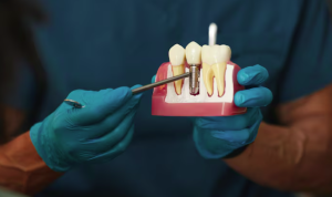 implantes dentales
