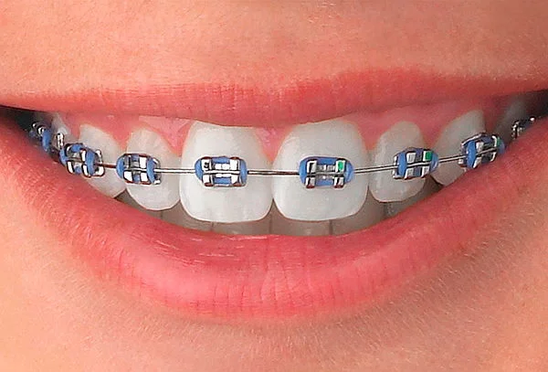 BRACKETS