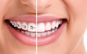 brackets vs alineadores