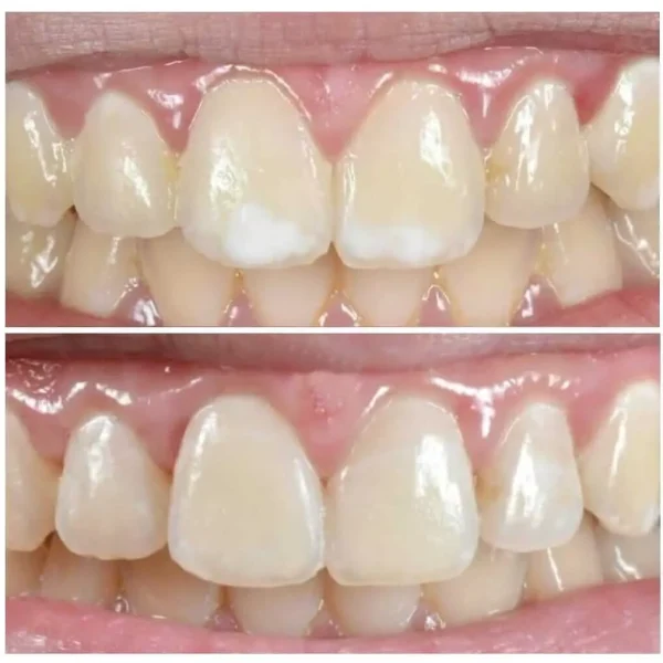 Caso real de cosmética adhesiva en Lima: antes y después – The Dental Clinic