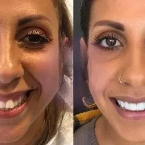 Antes y después de un tratamiento con carillas dentales — The Dental Clinic Lima