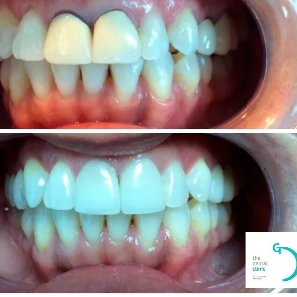 Caso real de coronas dentales en Lima: antes y después — The Dental Clinic
