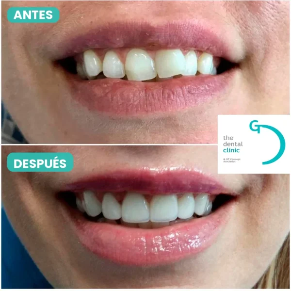 Caso real de diseño de sonrisa en Lima: antes y después – The Dental Clinic