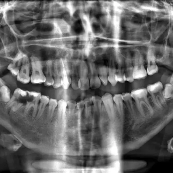 Radiografía panorámica que muestra una muela del juicio impactada