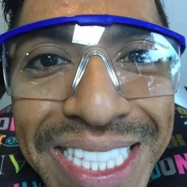 blanqueamiento dental caso real